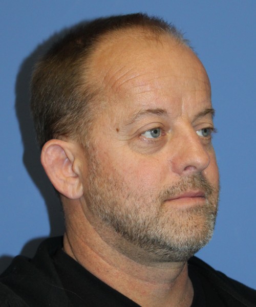 Blepharoplasty (eyelids), Facial Fat Grafting 4728 – Click HERE for more views before photo. Individual results may vary.