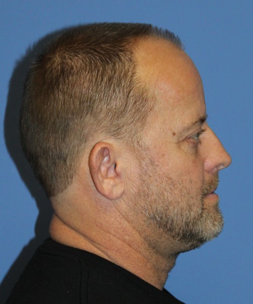 Blepharoplasty (eyelids), Facial Fat Grafting 4728 – Click HERE for more views after photo. Individual results may vary.