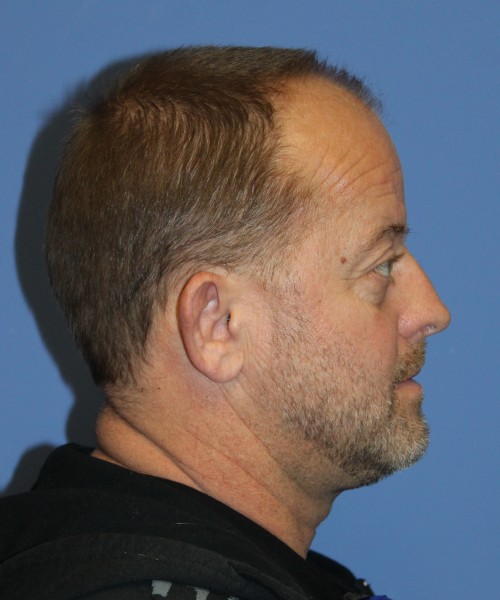 Blepharoplasty (eyelids), Facial Fat Grafting 4728 – Click HERE for more views before photo. Individual results may vary.