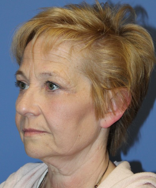 Blepharoplasty (eyelids) 4739 – click HERE for more views after photo. Individual results may vary.