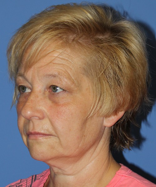 Blepharoplasty (eyelids) 4739 – click HERE for more views before photo. Individual results may vary.