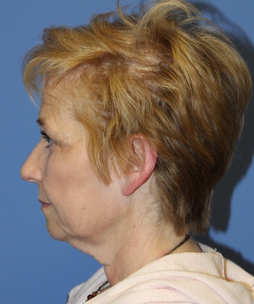 Blepharoplasty (eyelids) 4739 – click HERE for more views after photo. Individual results may vary.