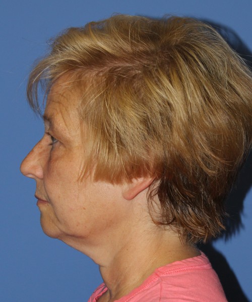 Blepharoplasty (eyelids) 4739 – click HERE for more views before photo. Individual results may vary.