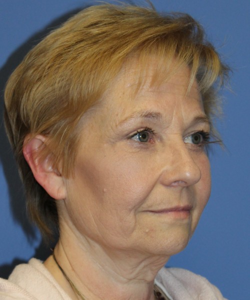 Blepharoplasty (eyelids) 4739 – click HERE for more views after photo. Individual results may vary.