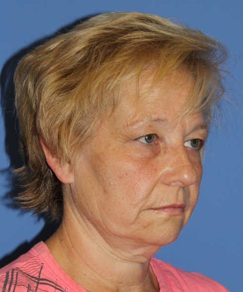Blepharoplasty (eyelids) 4739 – click HERE for more views before photo. Individual results may vary.