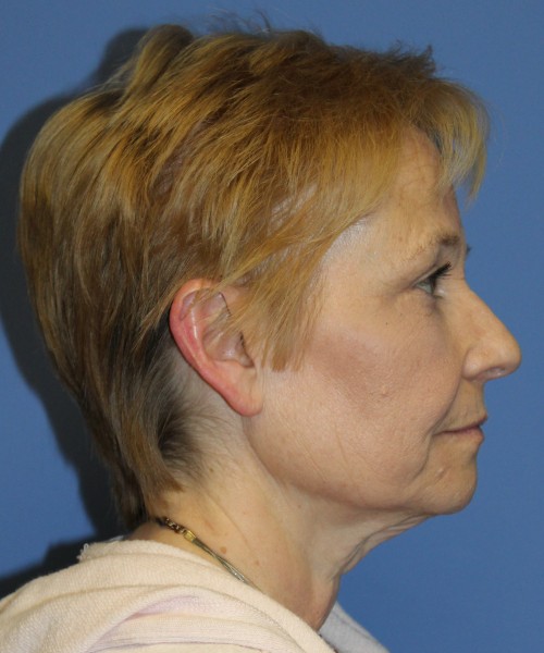 Blepharoplasty (eyelids) 4739 – click HERE for more views after photo. Individual results may vary.