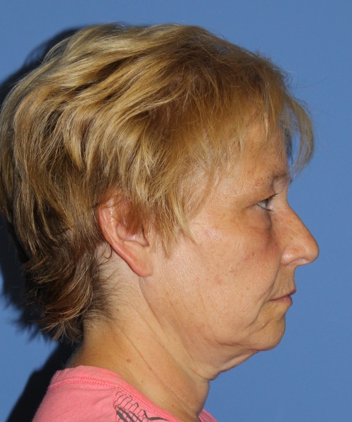 Blepharoplasty (eyelids) 4739 – click HERE for more views before photo. Individual results may vary.