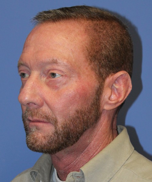 Blepharoplasty (eyelids) 4750 – Click HERE for more views after photo. Individual results may vary.