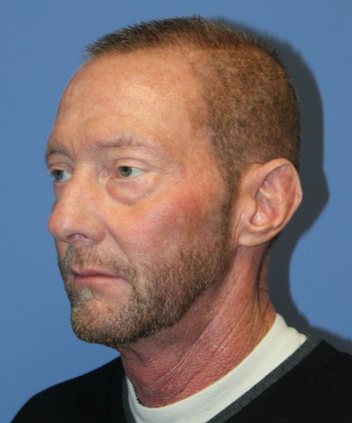 Blepharoplasty (eyelids) 4750 – Click HERE for more views before photo. Individual results may vary.