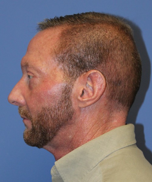 Blepharoplasty (eyelids) 4750 – Click HERE for more views after photo. Individual results may vary.