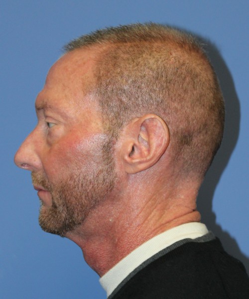 Blepharoplasty (eyelids) 4750 – Click HERE for more views before photo. Individual results may vary.