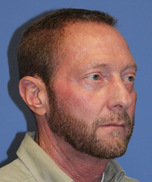 Blepharoplasty (eyelids) 4750 – Click HERE for more views after photo. Individual results may vary.