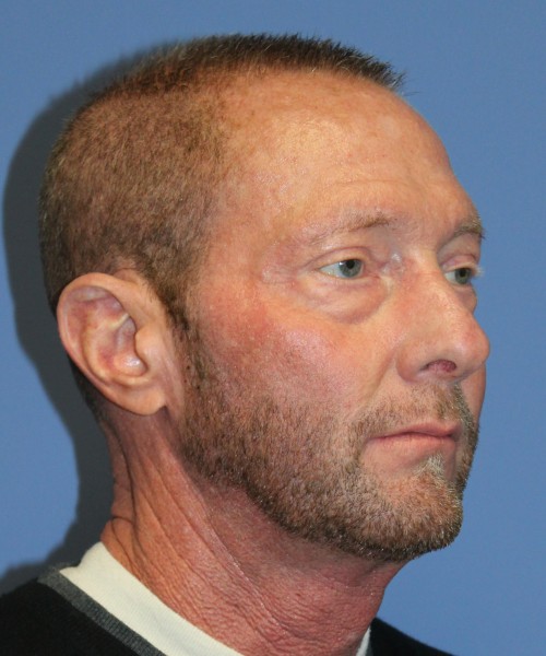 Blepharoplasty (eyelids) 4750 – Click HERE for more views before photo. Individual results may vary.