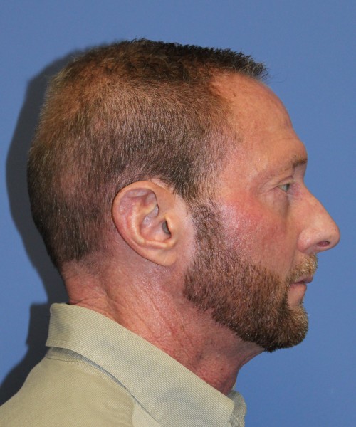 Blepharoplasty (eyelids) 4750 – Click HERE for more views after photo. Individual results may vary.