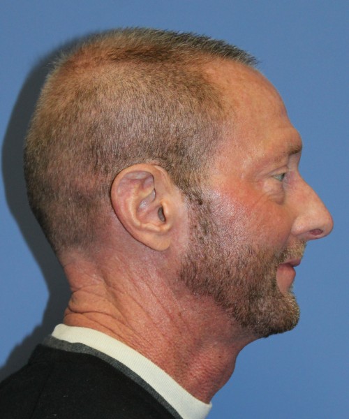 Blepharoplasty (eyelids) 4750 – Click HERE for more views before photo. Individual results may vary.