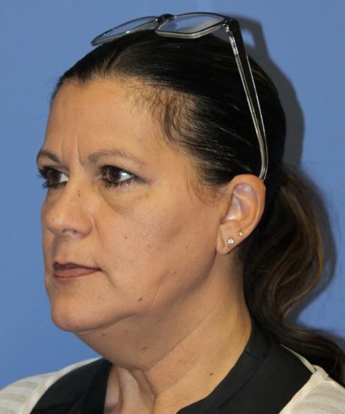 Blepharoplasty (eyelids) 4761 – Click HERE for more views after photo. Individual results may vary.