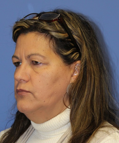 Blepharoplasty (eyelids) 4761 – Click HERE for more views before photo. Individual results may vary.
