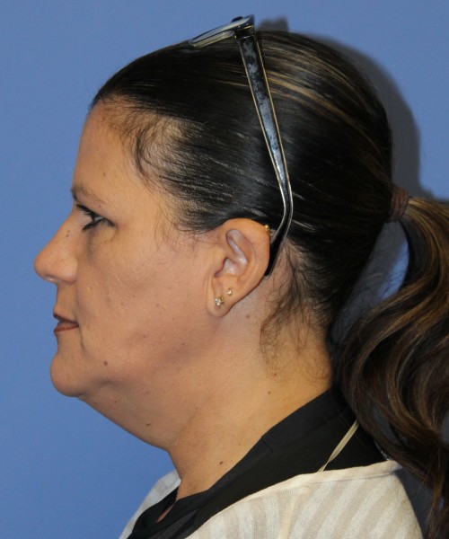 Blepharoplasty (eyelids) 4761 – Click HERE for more views after photo. Individual results may vary.