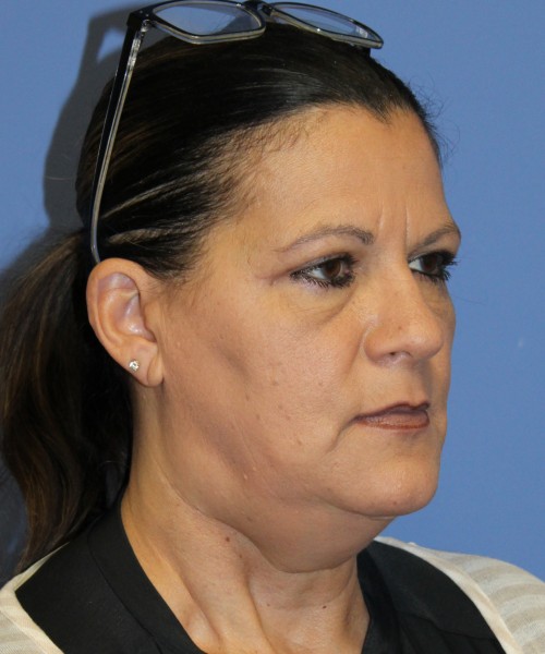 Blepharoplasty (eyelids) 4761 – Click HERE for more views after photo. Individual results may vary.