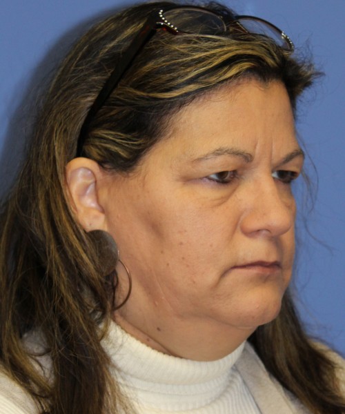 Blepharoplasty (eyelids) 4761 – Click HERE for more views before photo. Individual results may vary.