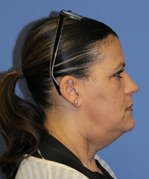 Blepharoplasty (eyelids) 4761 – Click HERE for more views after photo. Individual results may vary.