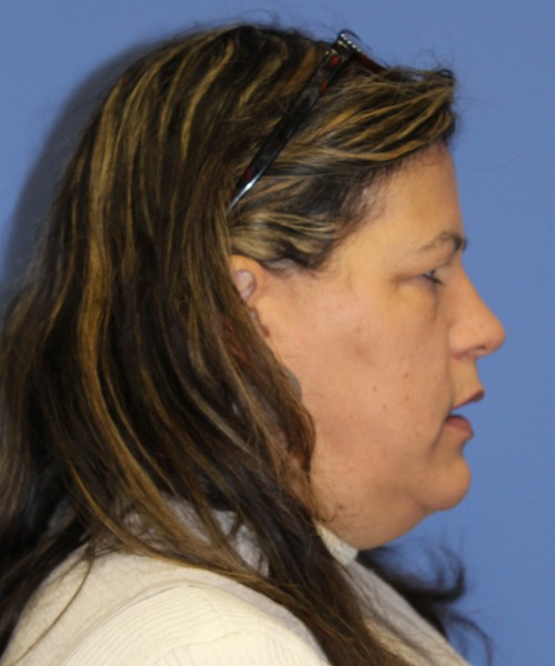 Blepharoplasty (eyelids) 4761 – Click HERE for more views before photo. Individual results may vary.