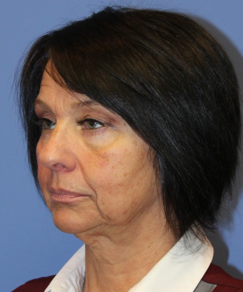 Blepharoplasty (eyelids) 4772 – Click HERE for more views after photo. Individual results may vary.
