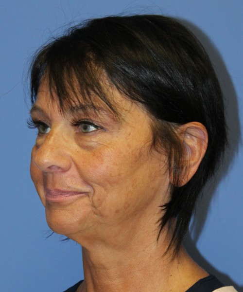 Blepharoplasty (eyelids) 4772 – Click HERE for more views before photo. Individual results may vary.