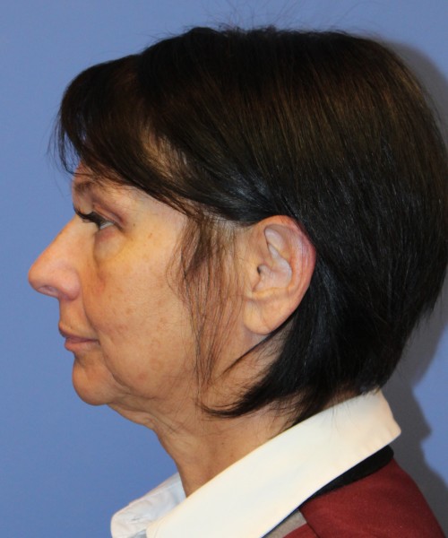 Blepharoplasty (eyelids) 4772 – Click HERE for more views after photo. Individual results may vary.