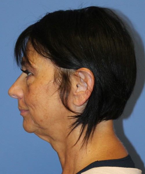 Blepharoplasty (eyelids) 4772 – Click HERE for more views before photo. Individual results may vary.