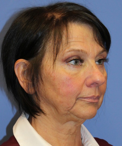 Blepharoplasty (eyelids) 4772 – Click HERE for more views after photo. Individual results may vary.