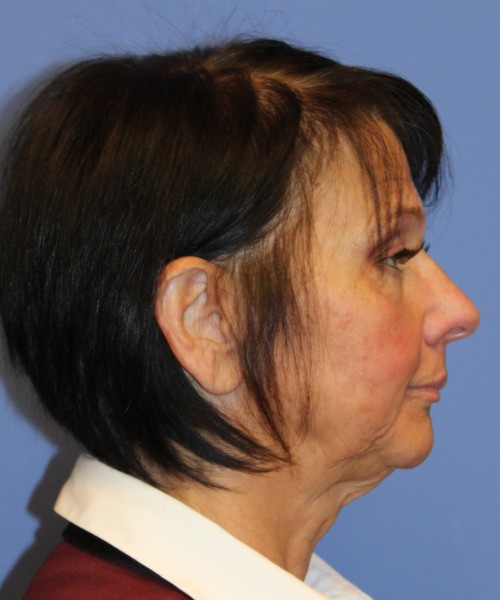 Blepharoplasty (eyelids) 4772 – Click HERE for more views after photo. Individual results may vary.
