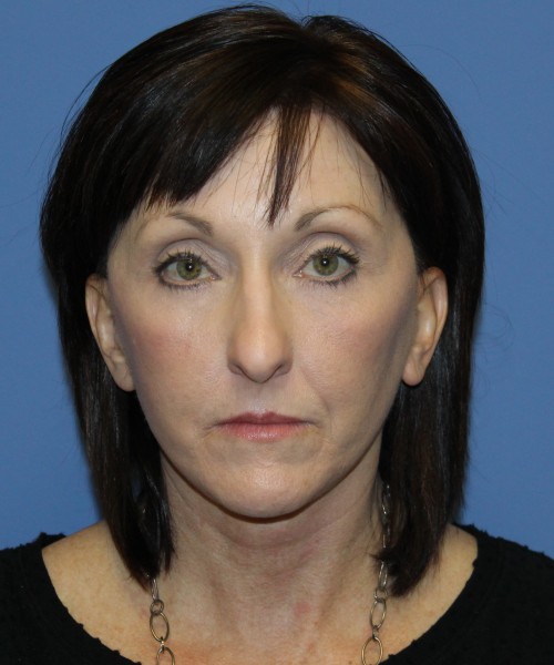 Facelift, Browlift, Lip Augmentation, Blepharoplasty (eyelids) 4784 – Click HERE for more views after photo. Individual results may vary.