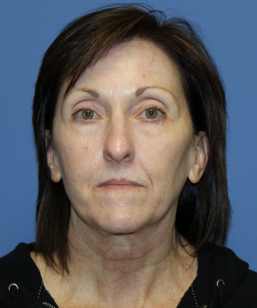 Facelift, Browlift, Lip Augmentation, Blepharoplasty (eyelids) 4784 – Click HERE for more views before photo. Individual results may vary.