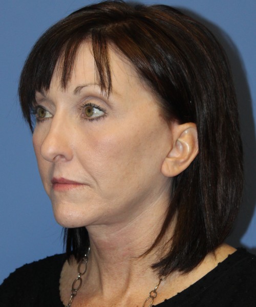 Facelift, Browlift, Lip Augmentation, Blepharoplasty (eyelids) 4784 – Click HERE for more views after photo. Individual results may vary.