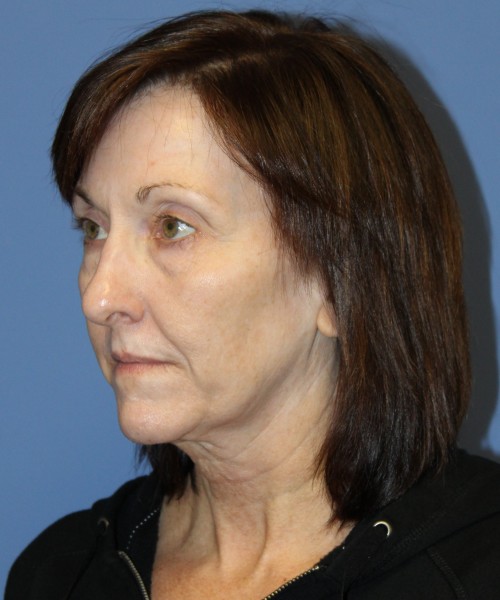 Facelift, Browlift, Lip Augmentation, Blepharoplasty (eyelids) 4784 – Click HERE for more views before photo. Individual results may vary.