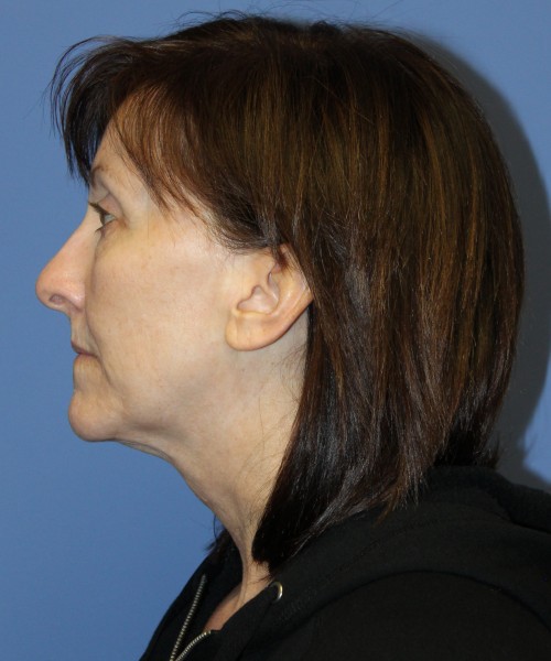 Facelift, Browlift, Lip Augmentation, Blepharoplasty (eyelids) 4784 – Click HERE for more views before photo. Individual results may vary.