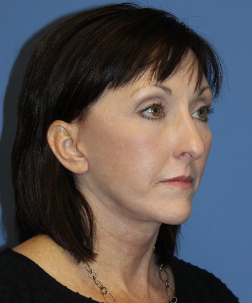 Facelift, Browlift, Lip Augmentation, Blepharoplasty (eyelids) 4784 – Click HERE for more views after photo. Individual results may vary.
