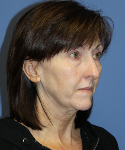 Facelift, Browlift, Lip Augmentation, Blepharoplasty (eyelids) 4784 – Click HERE for more views before photo. Individual results may vary.
