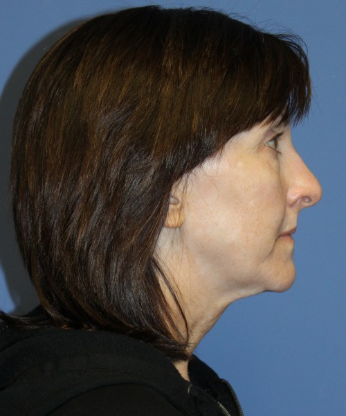 Facelift, Browlift, Lip Augmentation, Blepharoplasty (eyelids) 4784 – Click HERE for more views before photo. Individual results may vary.