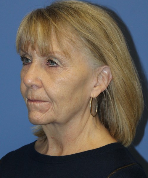 Facelift, Browlift, Blepharoplasty, Lip Augmentation 4806 – Click HERE for more views before photo. Individual results may vary.