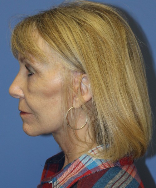Facelift, Browlift, Blepharoplasty, Lip Augmentation 4806 – Click HERE for more views after photo. Individual results may vary.