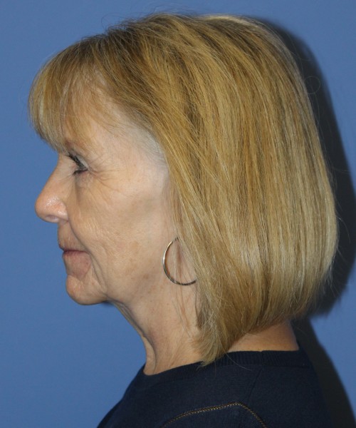 Facelift, Browlift, Blepharoplasty, Lip Augmentation 4806 – Click HERE for more views before photo. Individual results may vary.