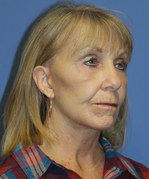 Facelift, Browlift, Blepharoplasty, Lip Augmentation 4806 – Click HERE for more views after photo. Individual results may vary.