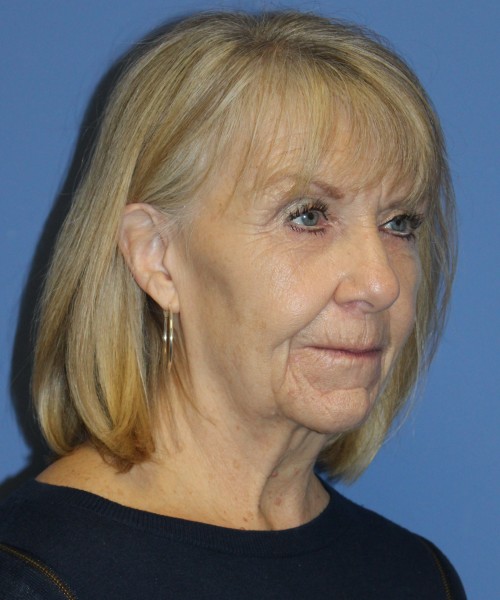 Facelift, Browlift, Blepharoplasty, Lip Augmentation 4806 – Click HERE for more views before photo. Individual results may vary.