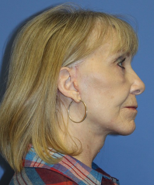 Facelift, Browlift, Blepharoplasty, Lip Augmentation 4806 – Click HERE for more views after photo. Individual results may vary.