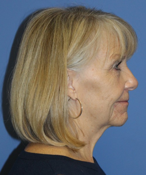Facelift, Browlift, Blepharoplasty, Lip Augmentation 4806 – Click HERE for more views before photo. Individual results may vary.