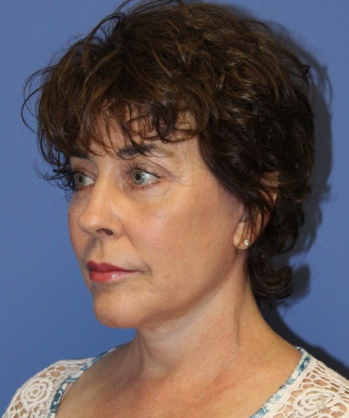 Facelift, Browlift, Lip Augmentation, Laser Skin Resurfacing 4818 – Click HERE for more views after photo. Individual results may vary.