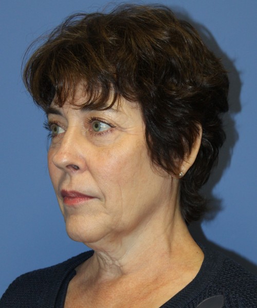Facelift, Browlift, Lip Augmentation, Laser Skin Resurfacing 4818 – Click HERE for more views before photo. Individual results may vary.