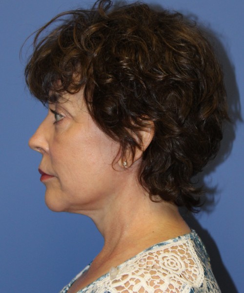 Facelift, Browlift, Lip Augmentation, Laser Skin Resurfacing 4818 – Click HERE for more views after photo. Individual results may vary.